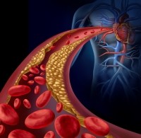 cardiovascular heart health blood cholesterol clogged iStock.com wildpixel