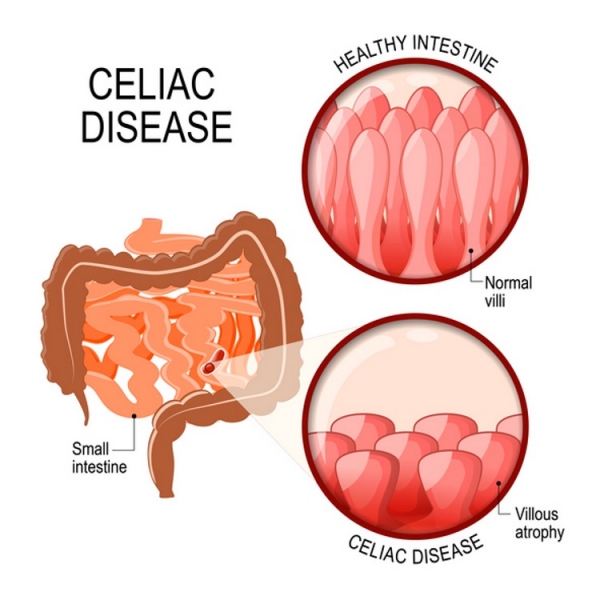 Celiac diseas Getty